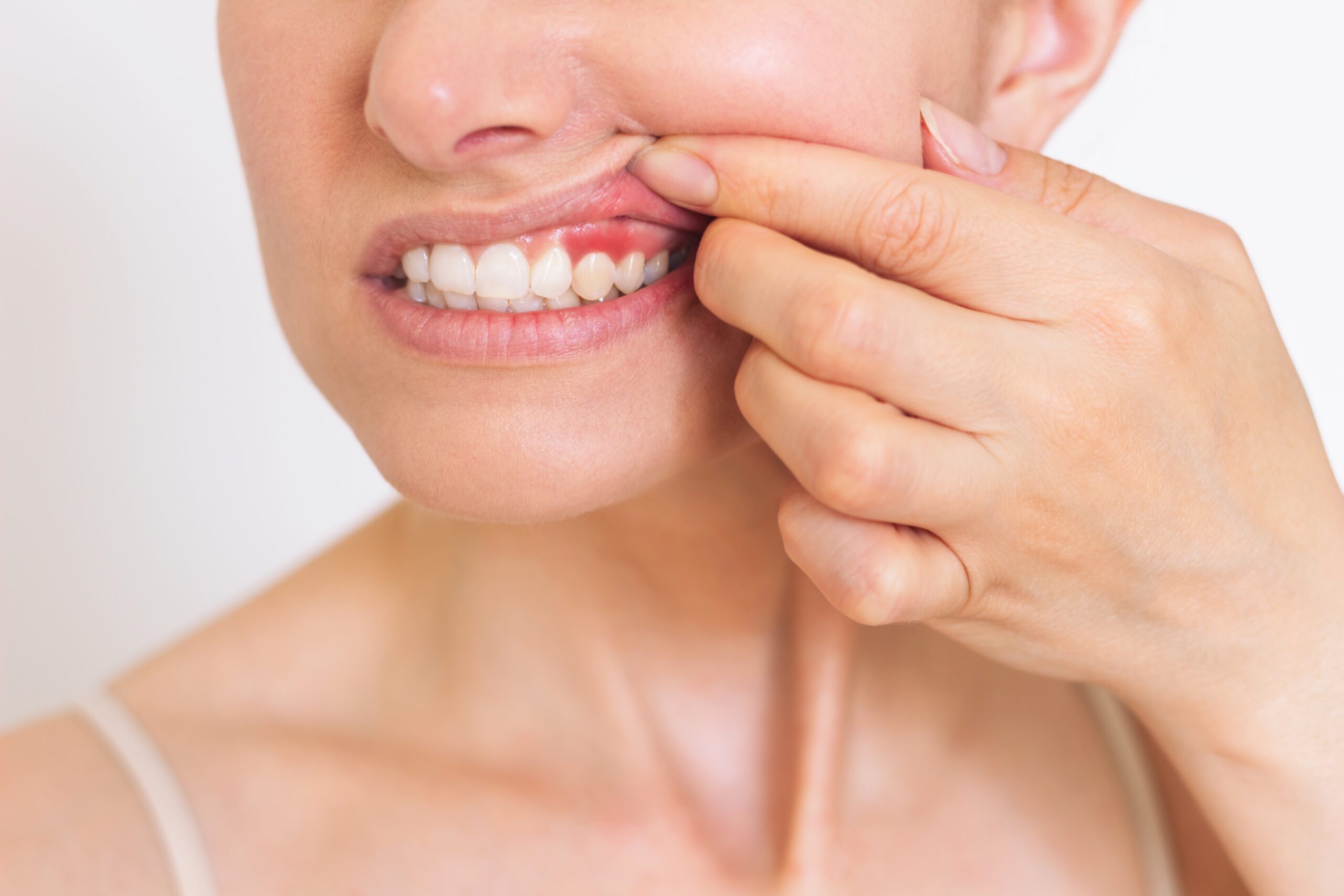 woman pulling up her lip to show red gums, early sign of gum disease