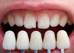 Comparing porcelain veneers to real teeth