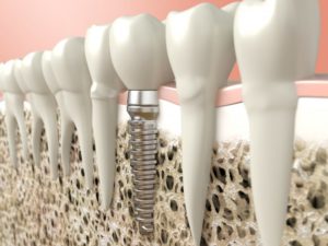 3-D animation of dental implant in gums