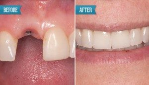 Before and after cosmetic dentistry