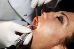 Woman with her mouth open for a dental procedure