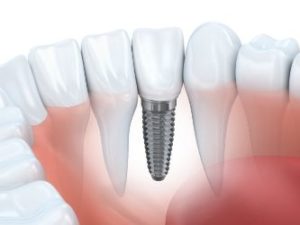 Animation of dental implant in gums