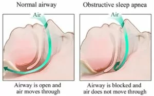 Diagram of normal airway vs. obstructive sleep apnea